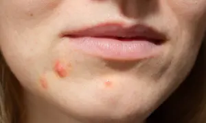 Zbliżenie na usta i policzek z widocznymi czerwonymi pryszczami.