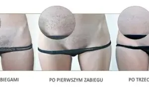 Depilacja bikini: Laser, wosk, pasta? Porównanie metod