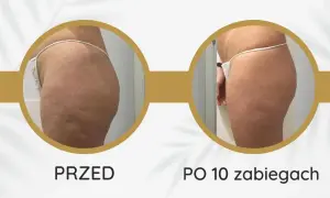 Endermologia: ile cm mniej? Realne efekty i sekrety sukcesu