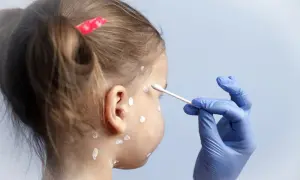Prawda o maści cynkowej na pryszcze: Kiedy pomoże, a kiedy nie?