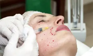 Mikrodermabrazja czy mezoterapia? Porównanie, efekty i ceny