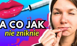 Masaż ust po kwasie hialuronowym: Czy to błąd? Ekspert radzi
