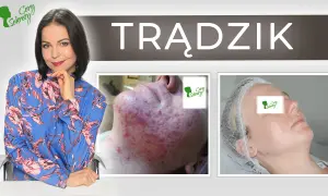 Od czego wychodzą pryszcze? Sekrety czystej cery poznaj je!