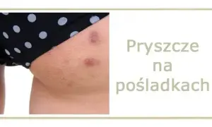 Co na pryszcze na pupie? Domowe SPA i pomoc dermatologa.