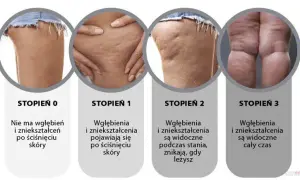 Jak szybko pozbyć się cellulitu? Skuteczne metody i porady