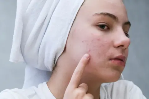 Młoda kobieta z ręcznikiem na głowie dotyka palcem policzka z pryszczami.