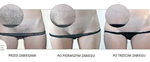 Depilacja bikini: Laser, wosk, pasta? Porównanie metod