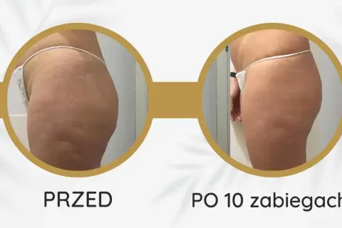 Endermologia: ile cm mniej? Realne efekty i sekrety sukcesu