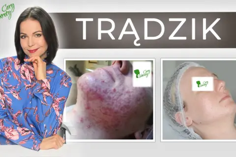 Od czego wychodzą pryszcze? Sekrety czystej cery poznaj je!
