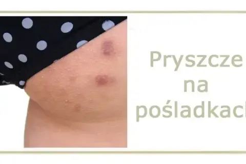 Co na pryszcze na pupie? Domowe SPA i pomoc dermatologa.