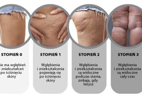 Jak szybko pozbyć się cellulitu? Skuteczne metody i porady