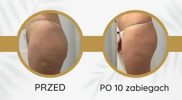 Endermologia: ile cm mniej? Realne efekty i sekrety sukcesu