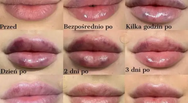Powiększanie ust: jak długo efekt? Czynniki i sposoby na trwałość