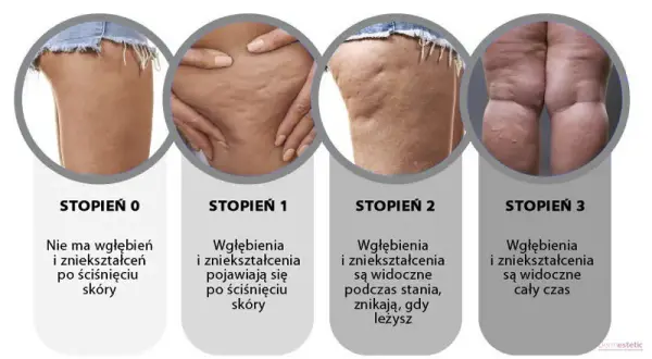Jak szybko pozbyć się cellulitu? Skuteczne metody i porady