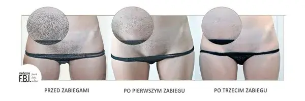 Depilacja bikini: Laser, wosk, pasta? Porównanie metod