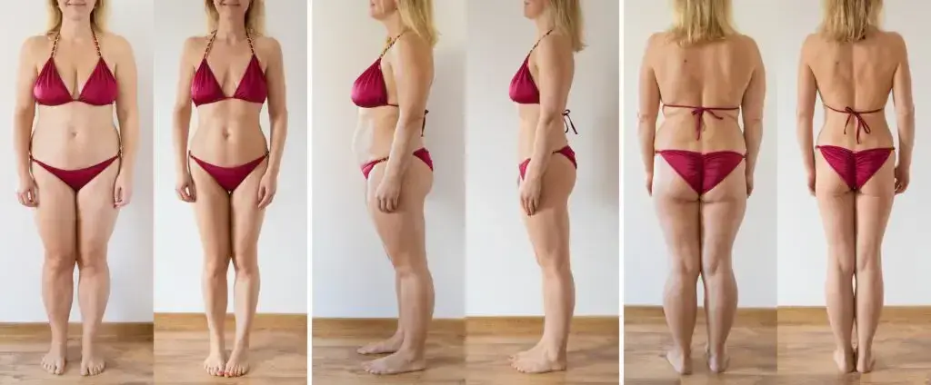 Liposukcja: Czy jest bezpieczna? Ryzyko, metody i rekonwalescencja