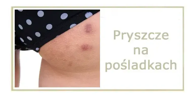 Co na pryszcze na pupie? Domowe SPA i pomoc dermatologa.