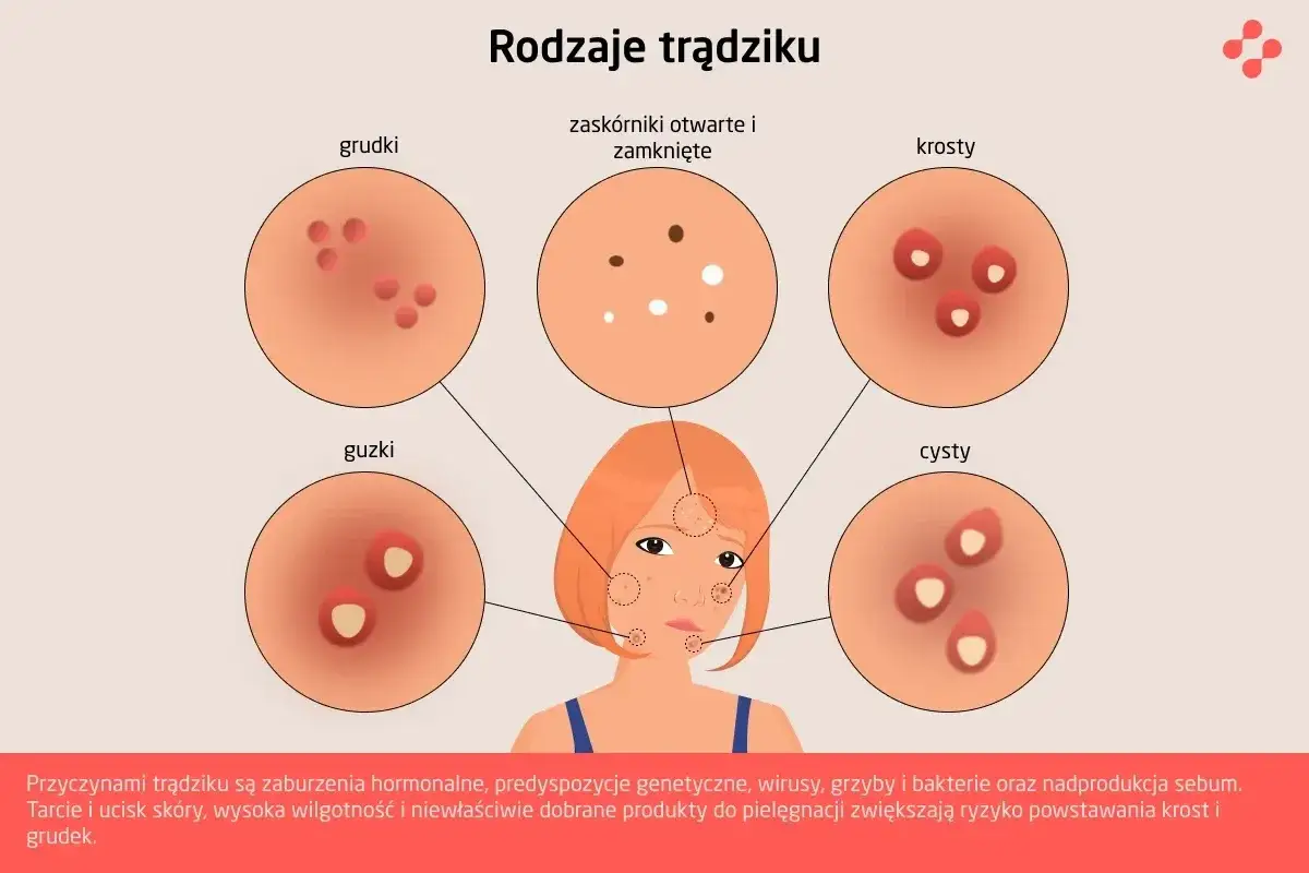 dieta a trądzik produkty szkodliwe korzystne