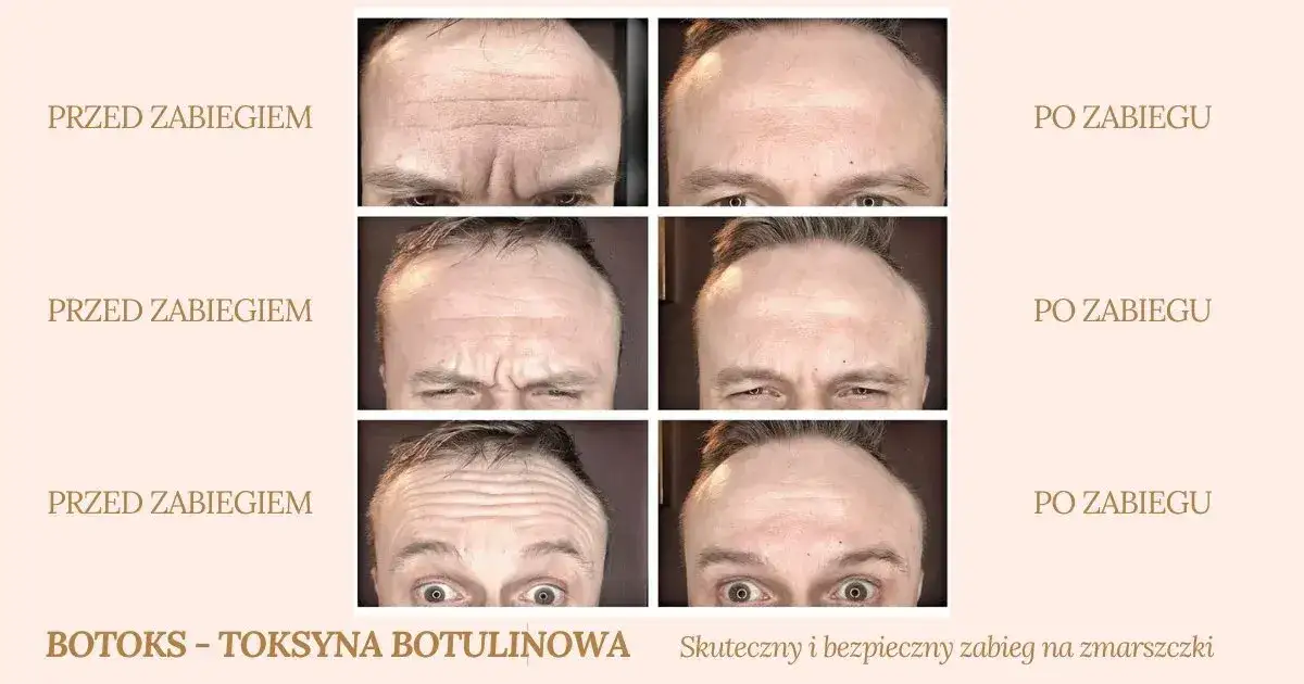korekta botoksu u lekarza medycyny estetycznej