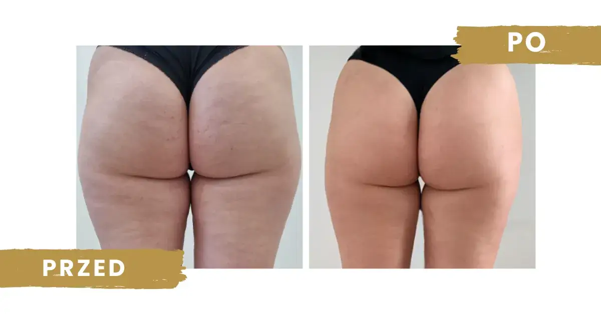 endermologia efekty przed i po cellulit