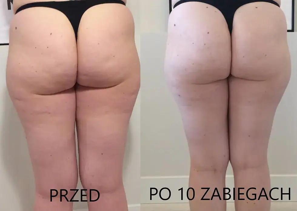 masaż bańką chińską przed i po