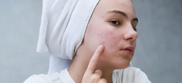 Młoda kobieta z ręcznikiem na głowie dotyka palcem policzka z pryszczami.