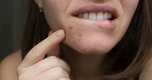 Jak wysuszyć pryszcze? Szybkie i bezpieczne triki na ratunek skórze