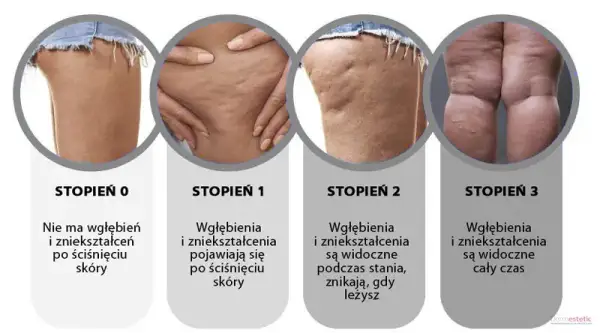 Jak szybko pozbyć się cellulitu? Skuteczne metody i porady